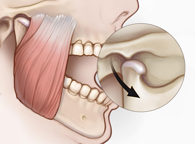 턱관절 디스크장애 예시 이미지